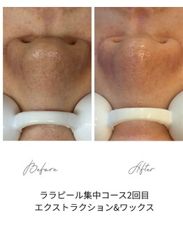 ジーンバイピエル 中野店(gene by PIEL)/#毛穴ケア#ピーリング#ワックス