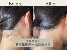 インベスト(INVEST)/うなじ脱毛