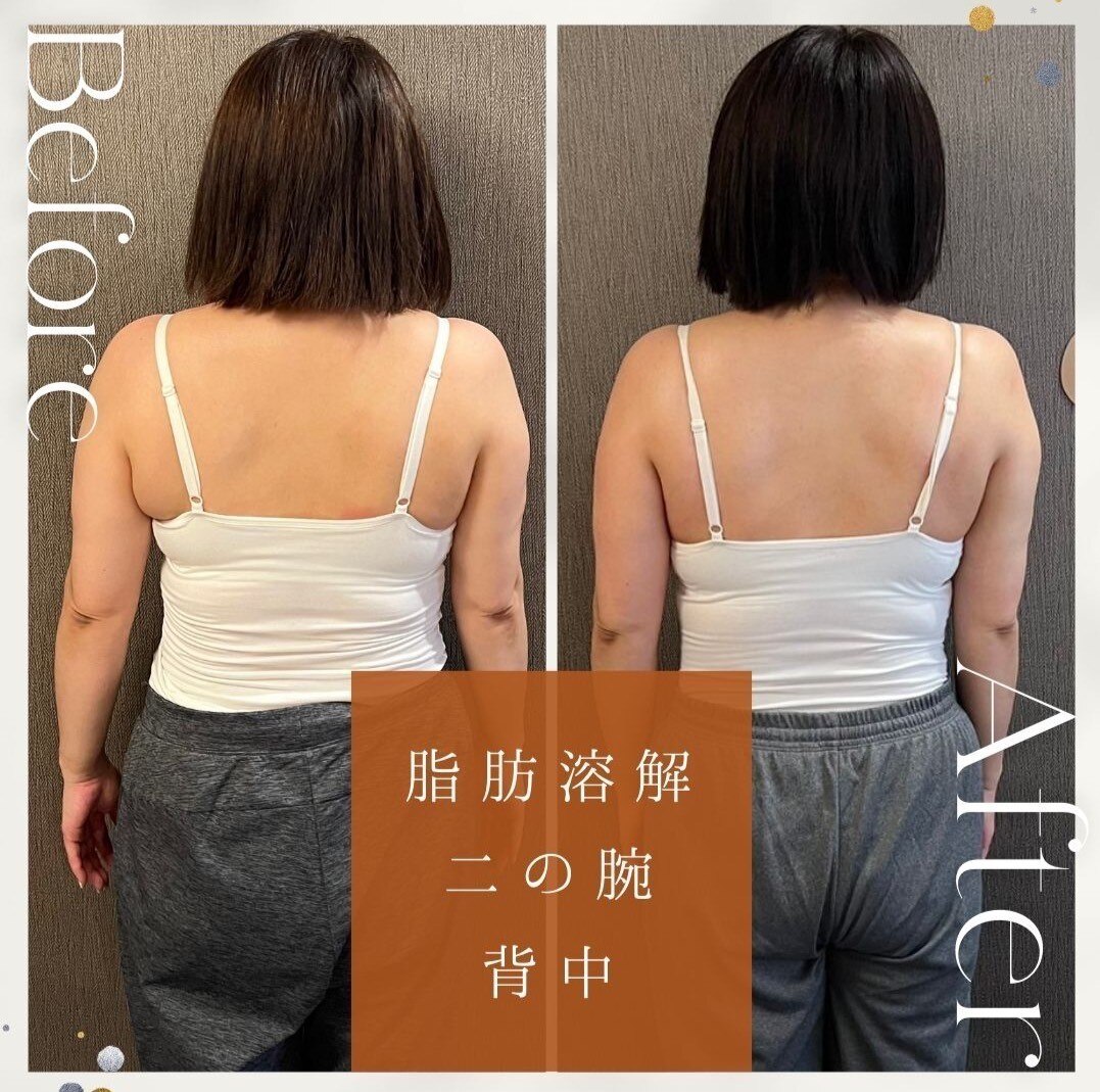 むくみ撃退！芸能人御用達サロン♪脂肪を溶かすクリーム