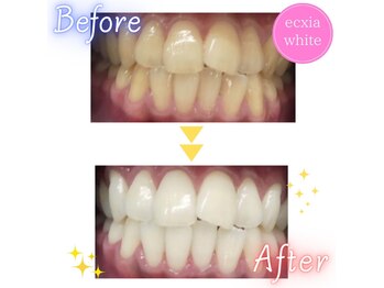 エクシアホワイトニング 徳島店