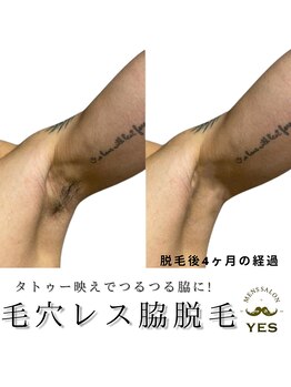 イエス 東京池袋店(YES)/脇脱毛