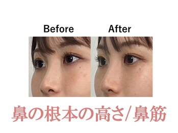 隆鼻矯正専門店 ラプリ(Raplit)/隆鼻＋輪郭矯正40分10回