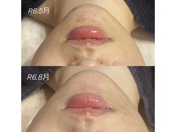 スピカ(Spica)/幹細胞で肌荒れ撃退!