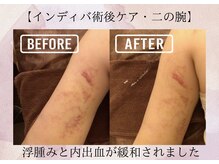 オキシー グレイス 小倉店(OXY Grace)/【インディバ術後ケア・二の腕】