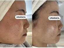 ウララカ(uraraca)/before・after