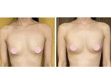 マリール(Marire)/30代・施術8回