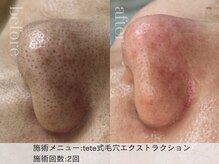 リエイト(Lieto)/teteしか毛穴エクストラクション