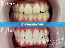 ホワイトニングカフェ 豊中店(WhiteningCafe)/◎歯のホワイトニング施術写真◎