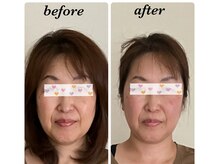 鍼灸庵利央/むくみが取れてフェイスライン◎