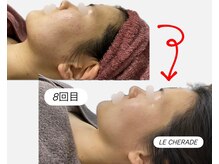 リシェラードの雰囲気（大人ニキビケア、凸凹肌改善も:)）