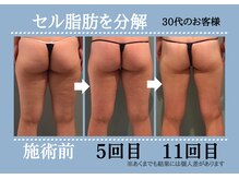 ボディエステティック アクアオーラ 高岡店/★脚とヒップの変化★