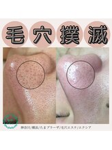 エクシア(Excia)/毛穴洗浄