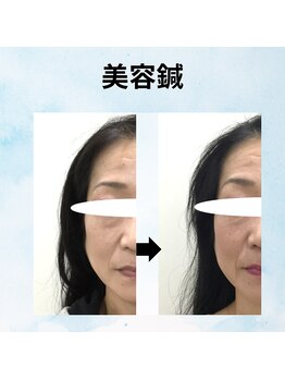 ゆず鍼灸整骨院/美容鍼