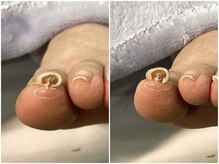 セイラ(Seila)/巻き爪