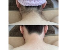ザ ビードットデザイン(The b. design)/うなじ脱毛