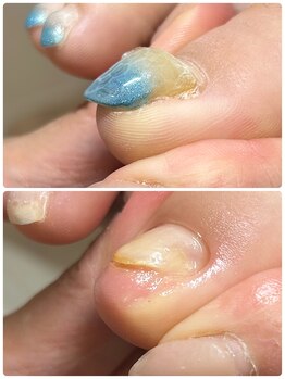 ココ ネイル サロン アンドスクール(COCO.NAIL SALON&SCHOOL)/トラブルフット5500