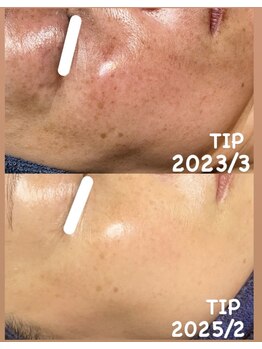 ミエル(miel)/【シミケア×ハーブピーリング】