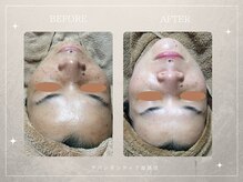 アバンダンティア 姫路店/シミデトックス×光フェイシャル