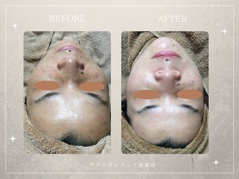 アバンダンティア 姫路店/シミデトックス×光フェイシャル