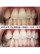 ホワイト 福岡天神店(WHITE)/ホワイトニングビフォーアフター