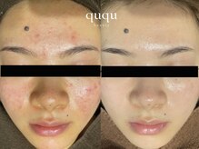 クク(ququ)/ニキビケアに