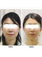 リリーガーデン 手稲店(Lily Garden)/ビフォーアフター　小顔/むくみ