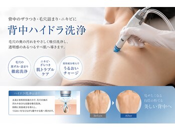 アイミービューティー(I'/me beatuy)の写真/自分でのケアには限界がある背面の徹底洗浄と皮脂詰まりをスッキリ 毛穴引き締めでツルツル背中へ◎