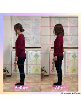 カイロプラクティック コダマ(KODAMA)/姿勢矯正　ビフォーアフター