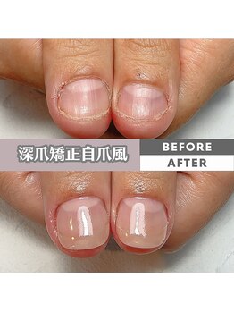 スマイルニコ(smile nico)/親指の深爪矯正