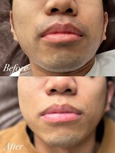 ボス 桑名店(BOSS)/ヒゲ脱毛【before after】#脱毛