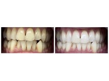 エクシアホワイトニング 日本橋店/40代男性