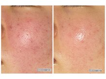 おうちサロン ミキ/肌質改善＊ハーブピーリング