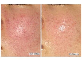 おうちサロン ミキ/肌質改善*ハーブピーリング