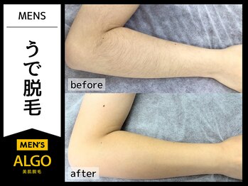 アルゴ 小松店(ALGO)/メンズ腕脱毛（10代学生）