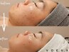 【U24専用】やさしく整えるのニキビケア