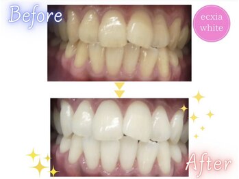 エクシアホワイトニング 草津店/ホワイトニングビフォーアフター
