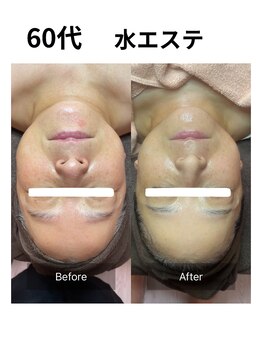 ヒール(heal)/赤み、小顔、シミ