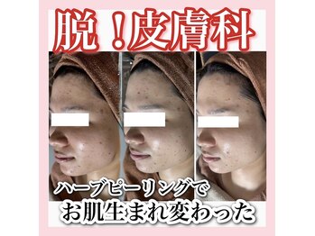 アルムダアクア 天王寺店(Aleumda AQUA)/ハーブピーリング/大阪/天王寺