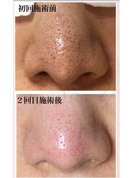 ナンバー511(No.511)/大人気!毛穴ケア!!