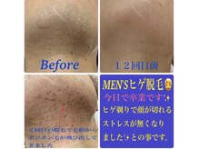 ラボーテ(La Beaute)/印象UP★men'sヒゲ脱毛