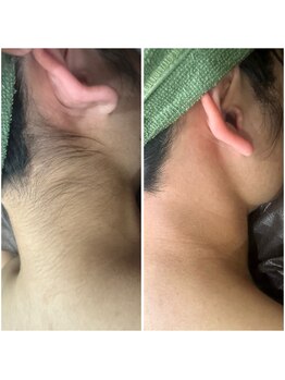 リモレア(RemoLe'a)/うなじ WAX＋光の[MIX脱毛]