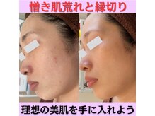 ファシル(Facile)/大人の肌荒れ改善