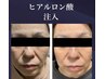 【目元クマ撃退！★選べる目元マシン2種使用50分/￥1回7500→2回で¥14000