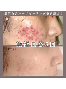 ベルミー(Bellmi)/肌質改善ハーブピーリング(顔)