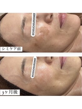 ミニョン(Mignon)/50代女性　シミケア改善写真