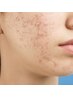 【右頬】ニキビ改善プログラム通常25,000円→初回12,500円