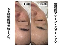 グラツィア(Grazia)/ヒト幹細胞高濃度導入！