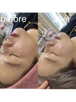 マホロバ(mahoroba)/(美容鍼×ララピール)マホロバ