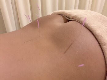 茶ノ木鍼灸整骨院/