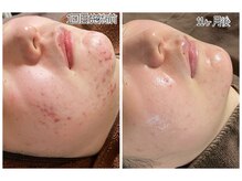 おうちサロン ミキ/肌質改善＊ハーブピーリング